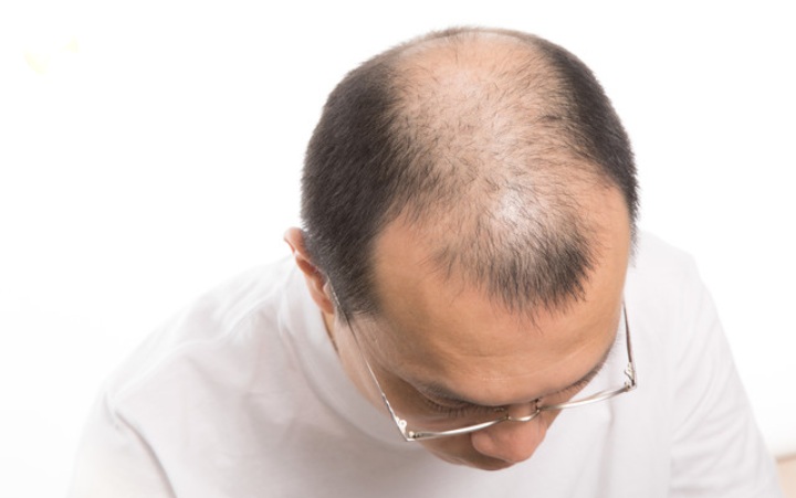 育毛初心者はまずチェック！男性の育毛で注意すること