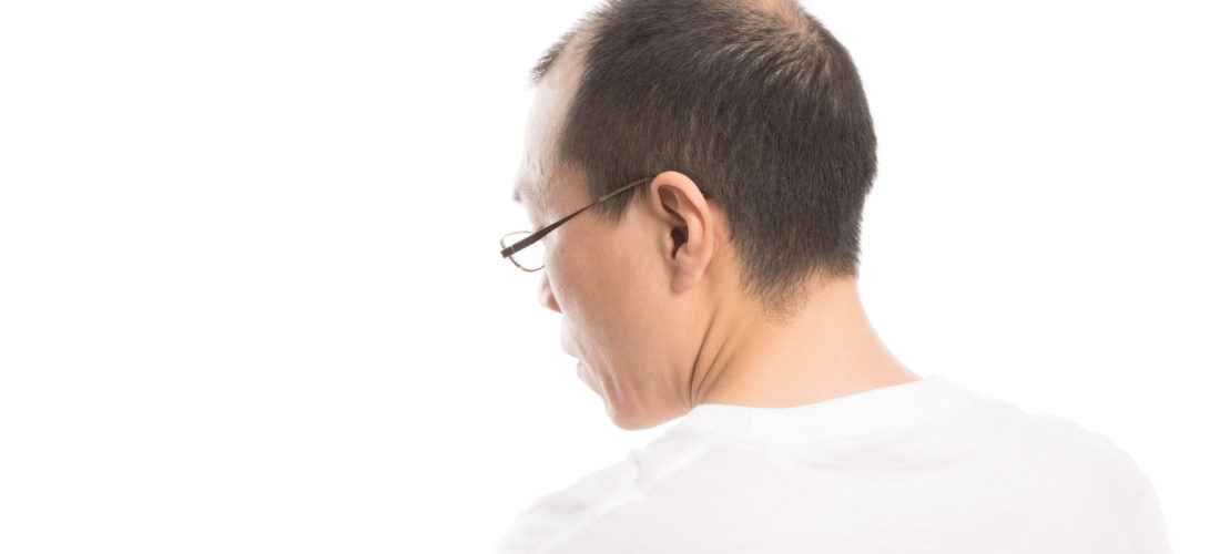 発毛剤に分類されているミノキジルとは？効果はあるの？