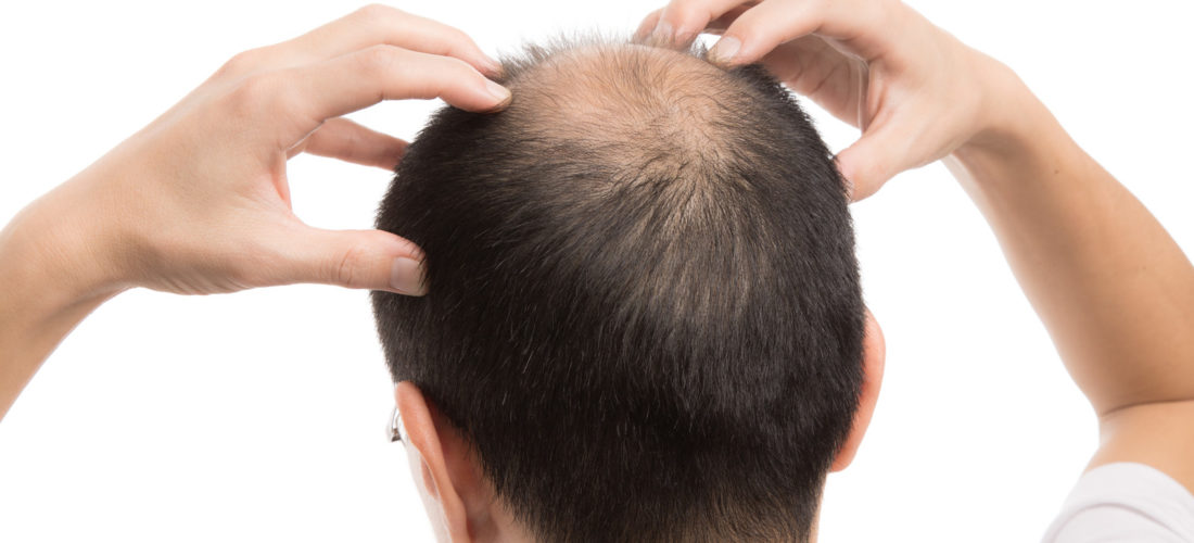 頭のてっぺんの薄いメンズ向けのおすすめヘアスタイル・スタイリング術は？