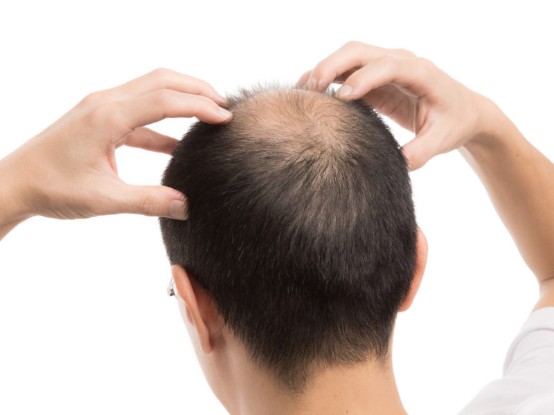 頭のてっぺんの薄いメンズ向けのおすすめヘアスタイル・スタイリング術は？