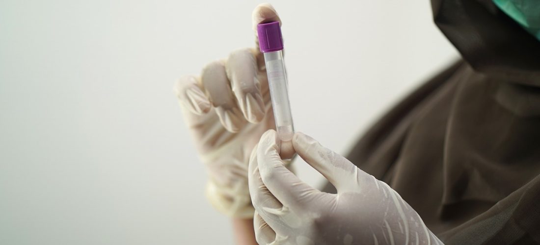 薄毛で悩んでいる人は遺伝子検査を行うべき?何が分かるの?