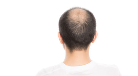 つむじが薄い20代がすべき5つの対策とは？