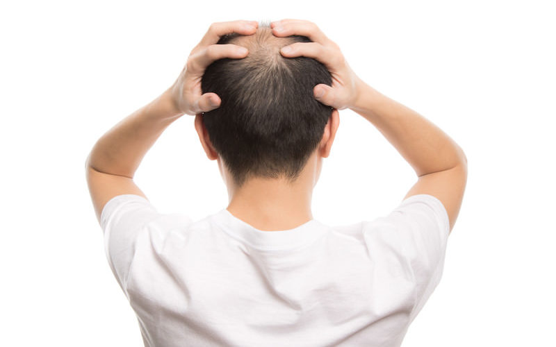 若はげの予防方法とは？原因から対策まで徹底解説