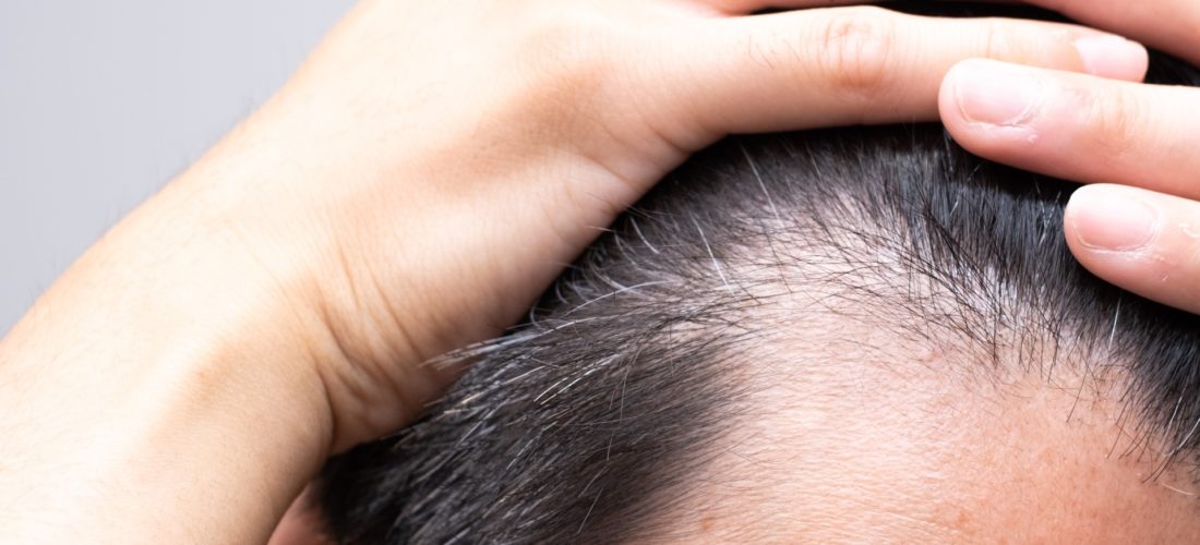 髪が柔らかい男はハゲやすいって本当？噂を化学的見地から徹底検証